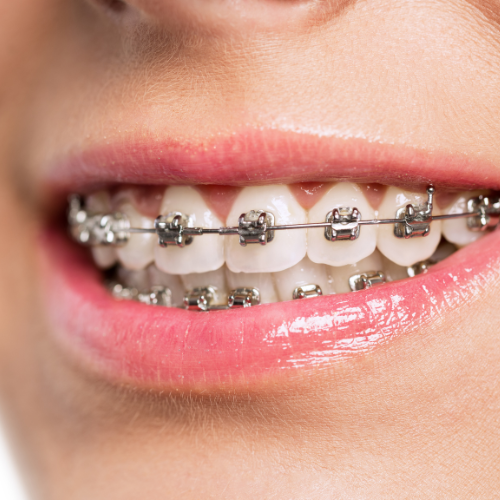 Braces are a dental solution used to straighten and align teeth, improving bite function and appearance, with long-term benefits for oral health.