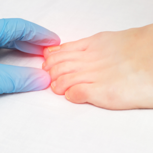 Toe nail fungus